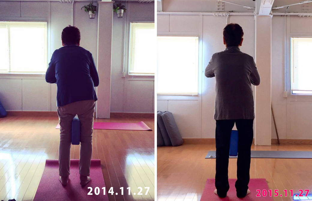 歳を重ねて腰が曲がってしまった女性が1年で腰がほぼまっすぐに改善された比較写真